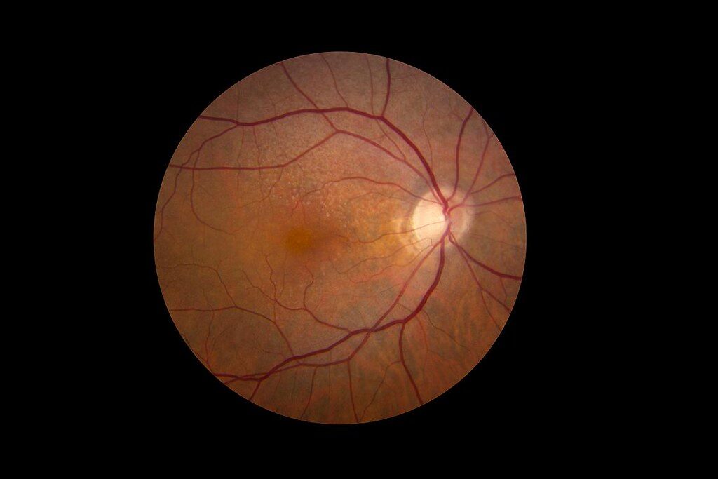 Retina showing reticular pseudodrusen
