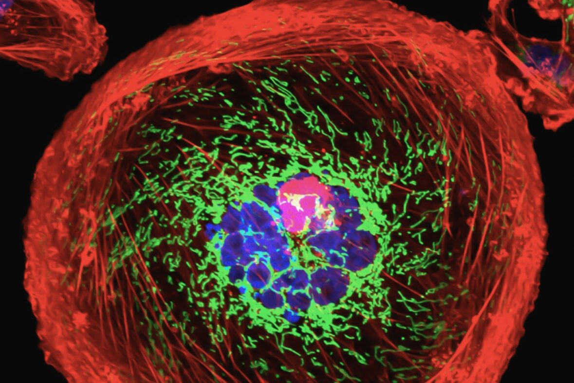 breast cancer cell